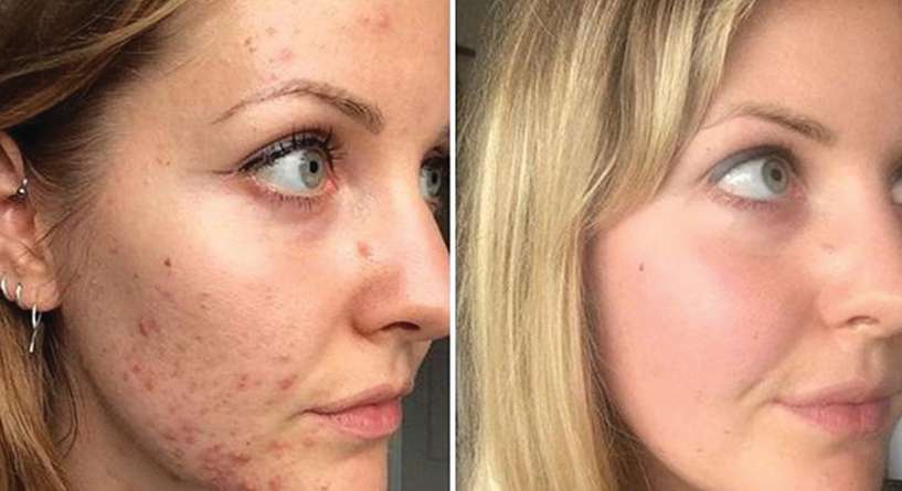 تخلصت من حب الشباب من خلال اتباع حمية عالية الدهون