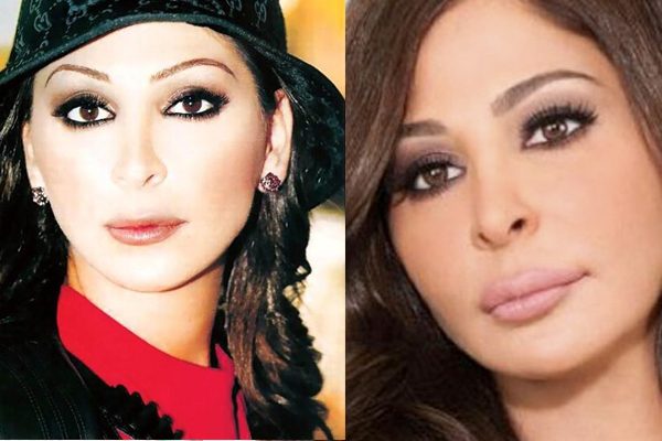 اليسا قبل وبعد تكبير شفتيها