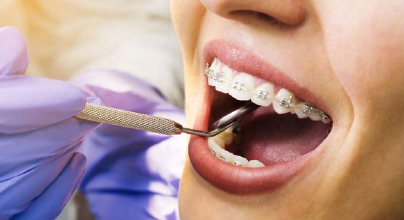 كيف يتم تركيب تقويم الاسنان