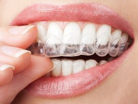 تقويم الاسنان الشفاف | كل شي عن التقويم الشفاف