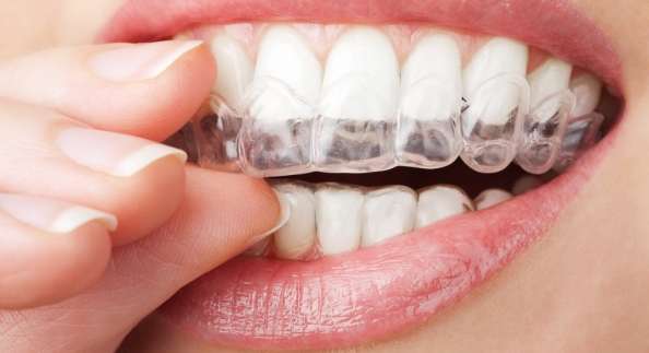 تقويم الاسنان الشفاف | كل شي عن التقويم الشفاف