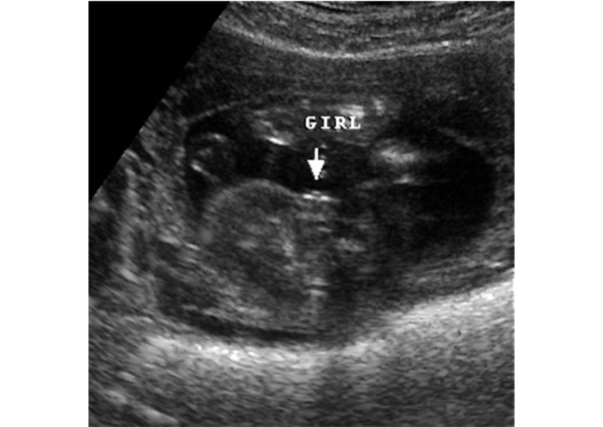كيف يكون شكل الجنين في الشهر الثالث بالسونار