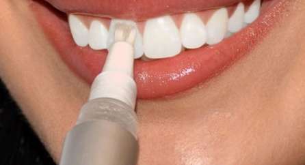 قلم تبييض الاسنان | طريقة لتبيض الاسنان