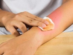 اكتشفي كيفية علاج الحروق في المنزل طبيعيا!