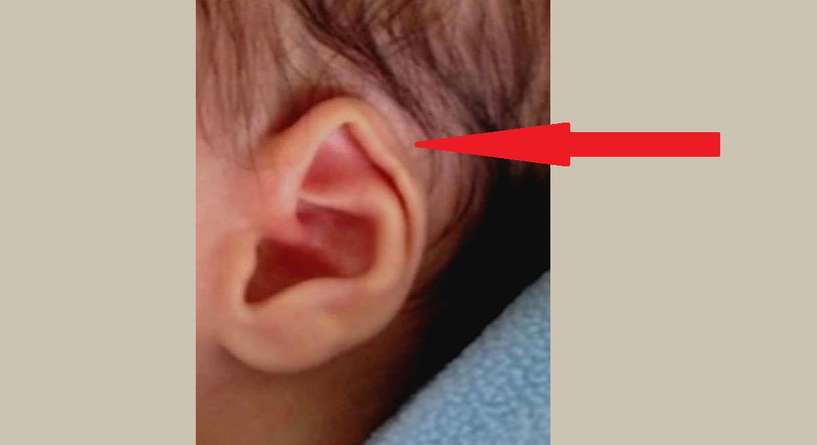 حيلة سهلة لتعديل شكل أذن الطفل الرضيع
