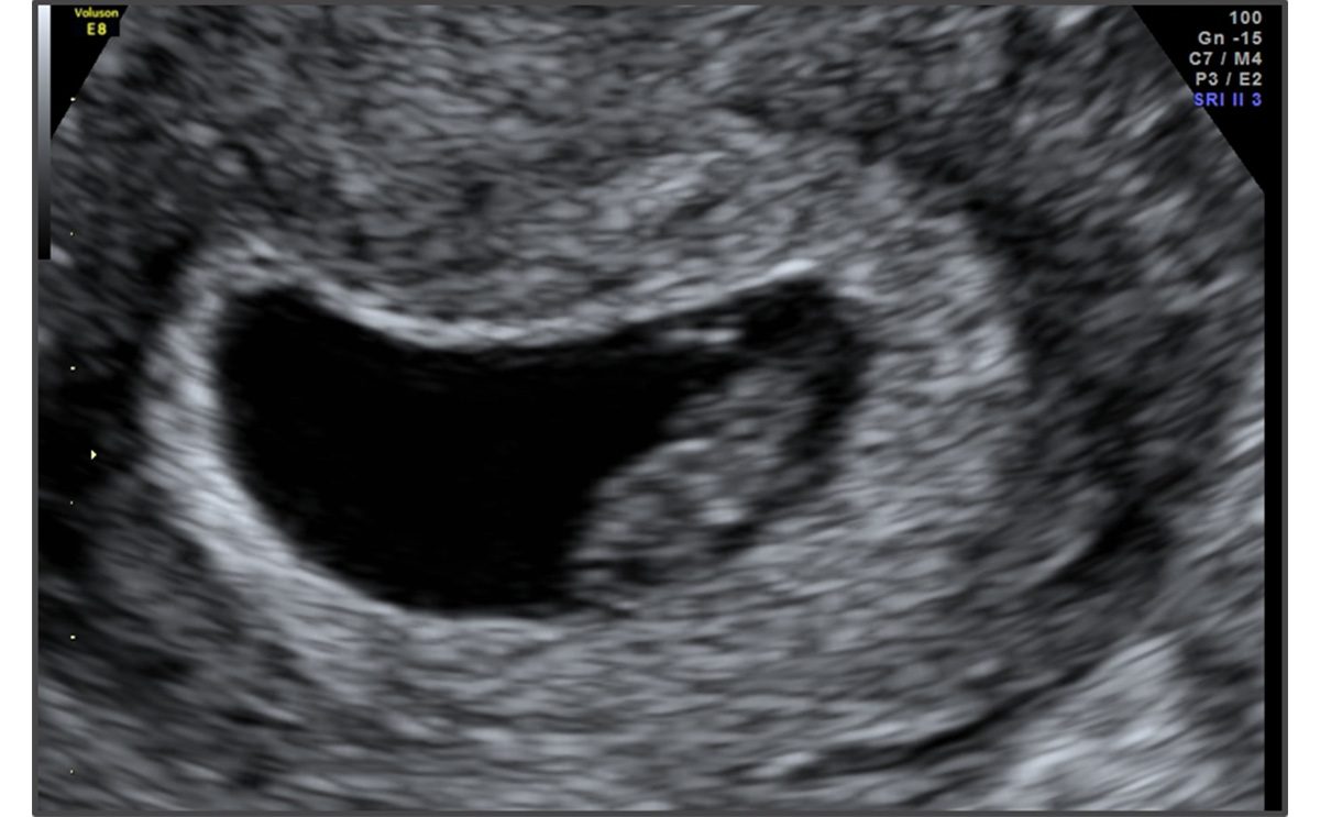 Через 6 8 недель. Плод на 7 неделе беременности УЗИ. Эмбрион на 7 неделе беременности УЗИ 3д. Зародыш 8 недель УЗИ.
