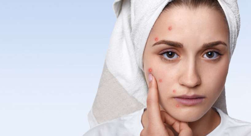 تعرفي الى أسباب ظهور الحبوب في الوجه بعد الثلاثين وعلاجها!