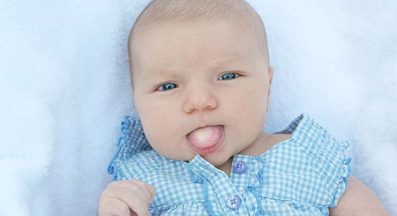 اعراض فطريات الفم عند الرضع 