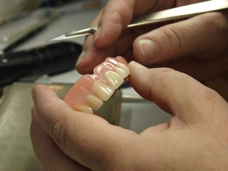 كيف يتم تحضير جسورالأسنان؟