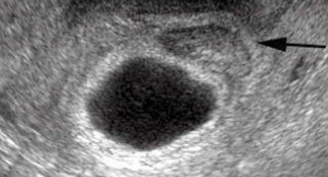 أسباب الحمل اللاجيني