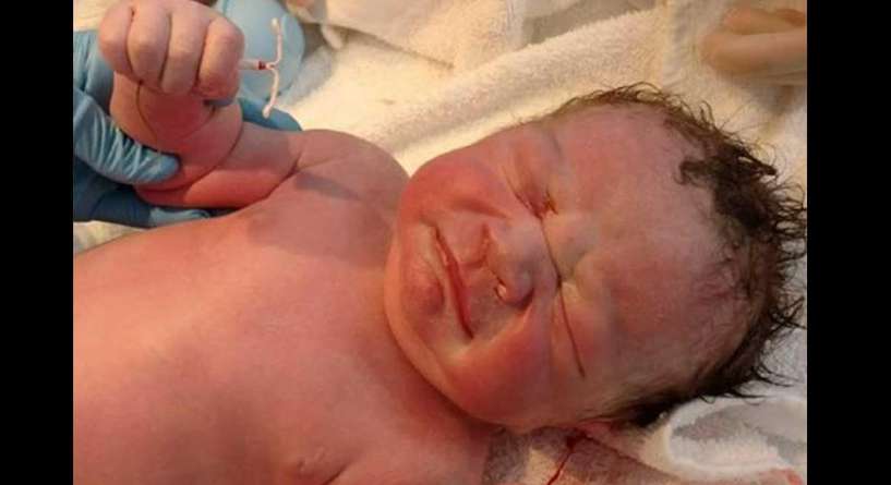 طفل يولد ممسكا باللولب الذي استخدمته والدته لمنع الحمل