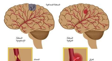 السكتة الدماغية: ماهيتها أسبابها وأعراضها