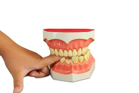 جسور الأسنان هل تؤثر على النطق؟