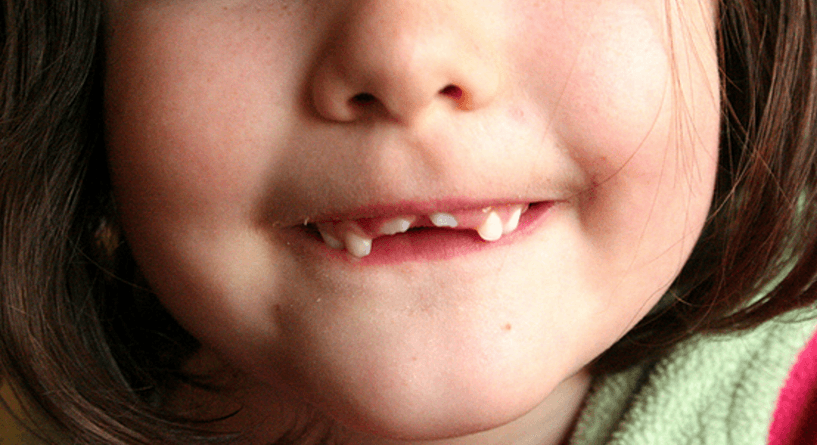 نصائح لعلاج جروح وكسور الاسنان عند الاطفال 