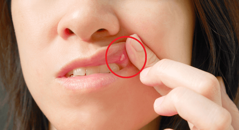 اسباب ظهور البثور البيضاء في الفم