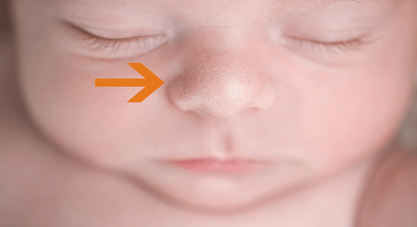 اسباب ظهور حبوب بيضاء في وجه الرضيع