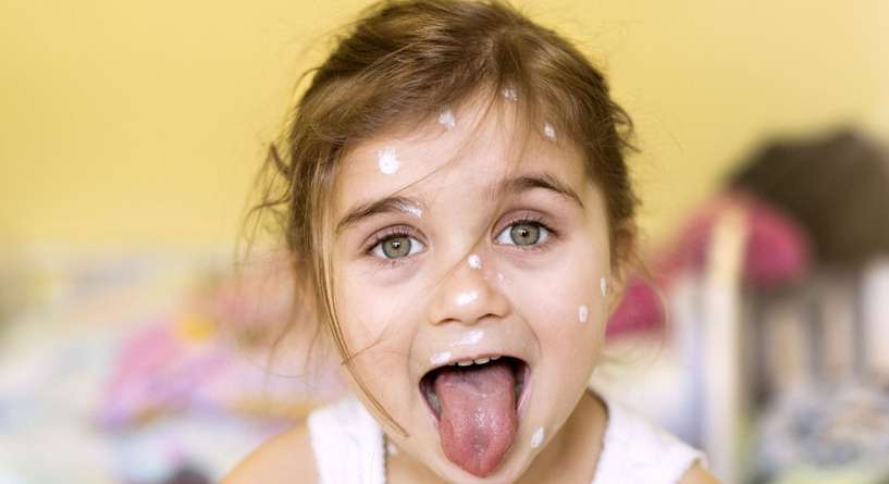 ما هو علاج جدري الماء عند الاطفال