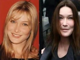 صور صادمة لنجمات شوّهت عمليات التجميل جمالهن
