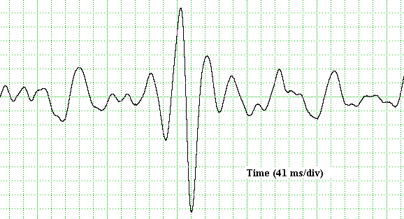 جهاز تخطيط القلب | جهاز رسم قلب