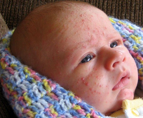 علاج الحبوب عند الاطفال الرضع