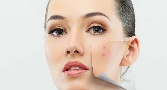 خلطات للتخلص من حب الشباب