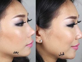 تقنية لرفع الأنف من دون عملية جراحية