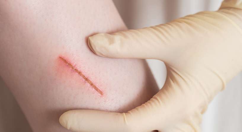 الصديد بعد العمليات الجراحية