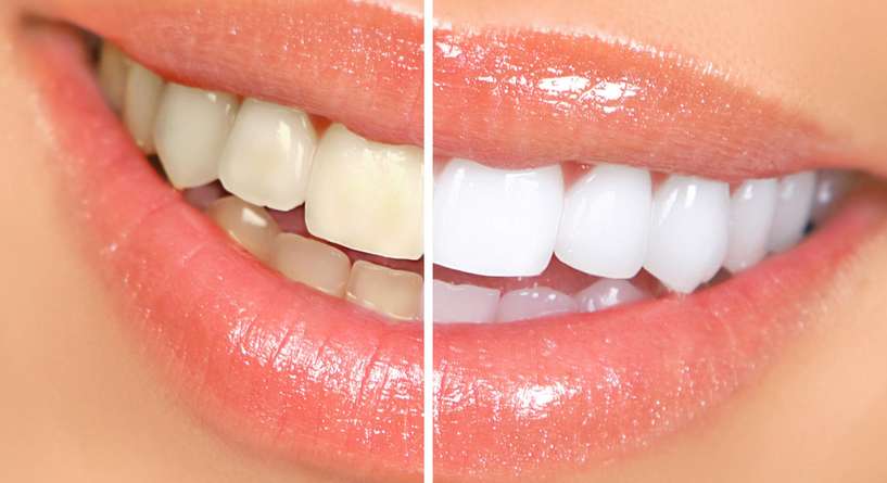كيف تحافظين على ثبات نتيجة تبييض أسنانك؟
