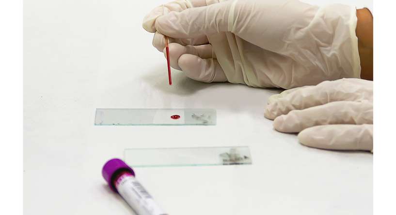 نسبة التحليل الهرموني للحمل خارج الرحم