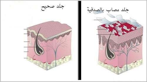 الصدفية وحساسية الجلد: ما الفرق بينهما؟