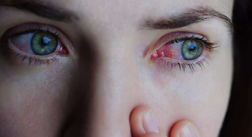 ما سبب احمرار العين بعد النوم وطريقة علاجه؟