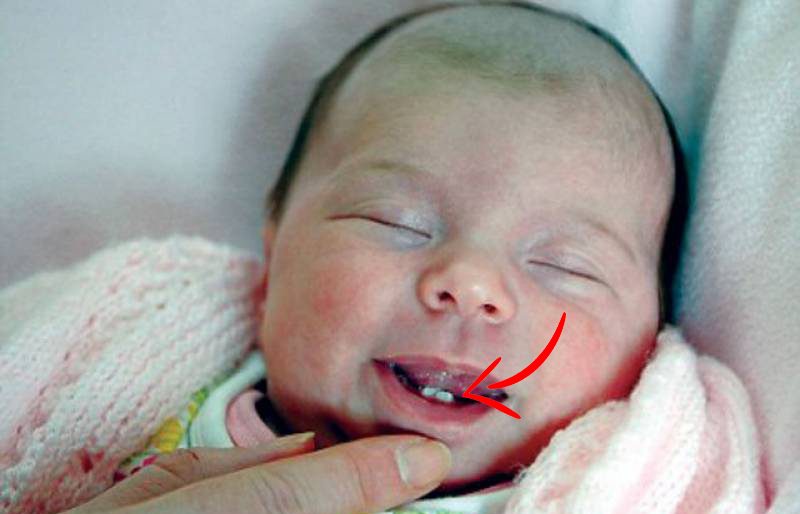 ولادة الطفل بأسنان ظاهرة
