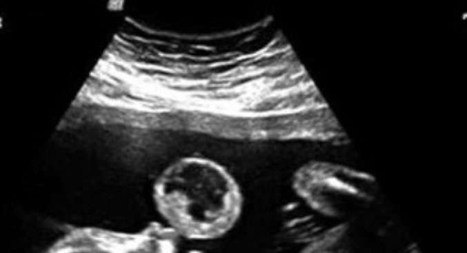 بم يتميز الأسبوع السابع عشر للحمل؟