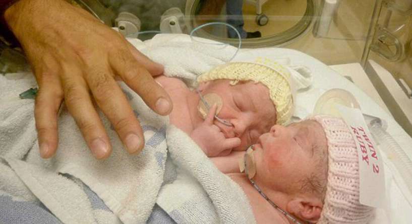 التوأم المتصل بعد 4 سنوات بالصور