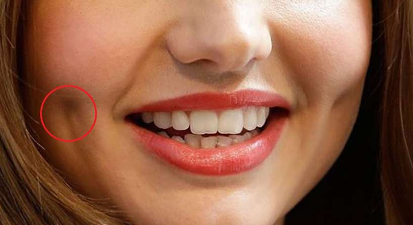 معلومات عن عملية غمازات الخد