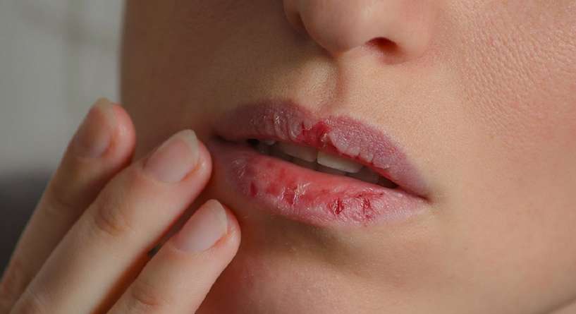 اسباب تشقق الشفايف وطرق العلاج