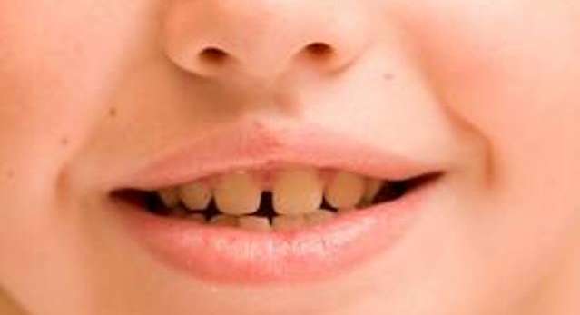 اصفرار اسنان الاطفال