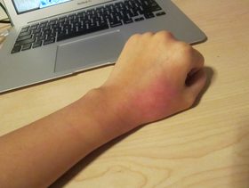 افضل كريم للحروق وغيره