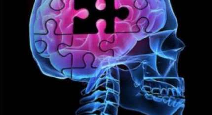 الألزهايمر