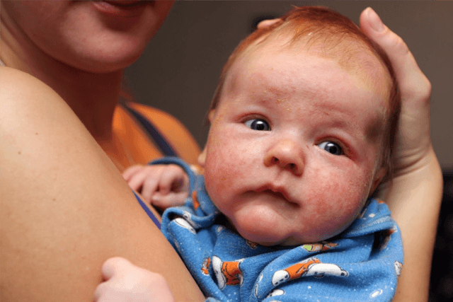طرق علاج اكزيما الرضع