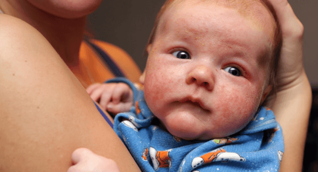 طرق علاج اكزيما الرضع