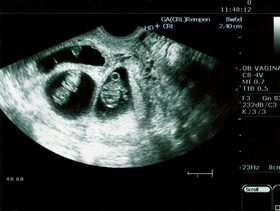 اخطاء السونار في التوأم والبنت والولد