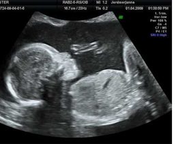 اسباب تشابه اعضاء الجنين الذكر والانثى في الشهر الرابع