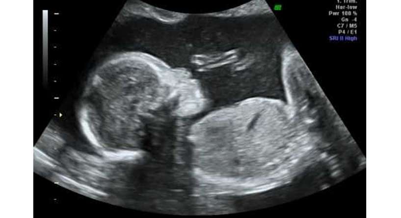 اسباب تشابه اعضاء الجنين الذكر والانثى في الشهر الرابع