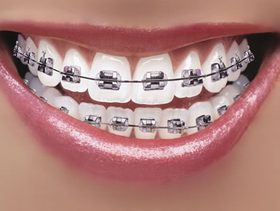 مقوّم الأسنان مصدر للجراثيم!