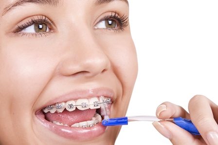 ما الخطوات التي تلي تقويم الأسنان؟