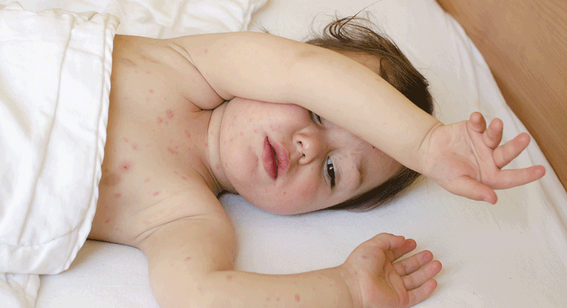علاج الطفح الجلدي عند الاطفال