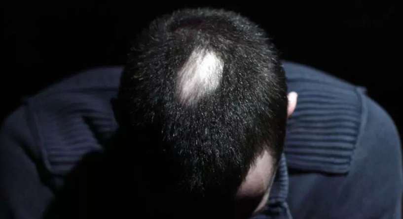 تعرفي الى اسباب مرض ثعلبة الشعر وطرق العلاج الطبيعية!