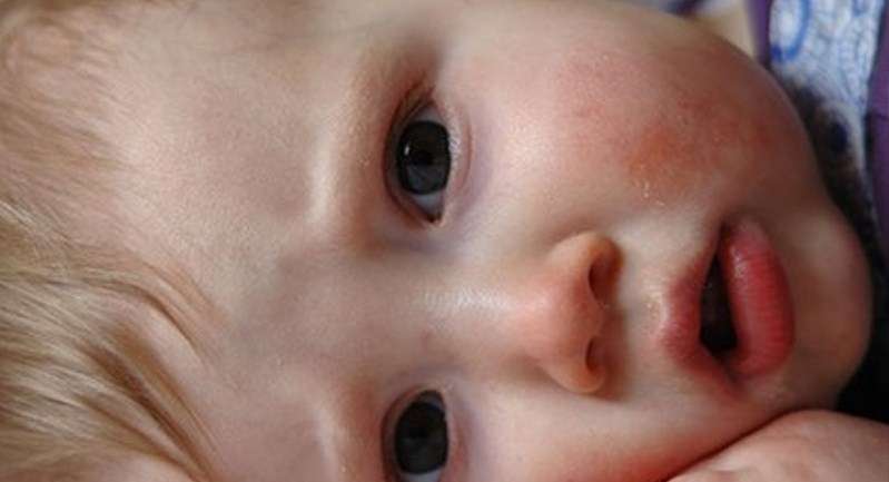 ما هو السبب المحتمل لإصابة الطفل بالاكزيما؟
