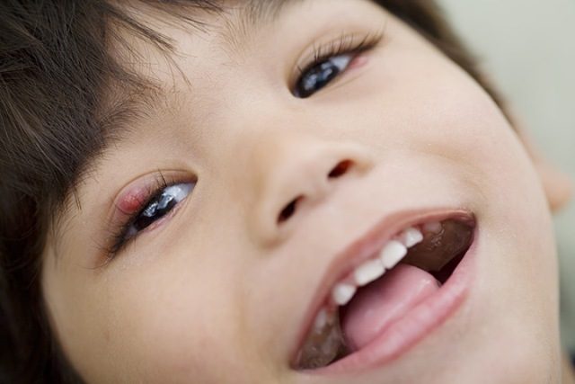 علاج شحاذ العين عند الاطفال
